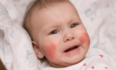 Infant Skin Allergy Treatment - A Comprehensive Guide