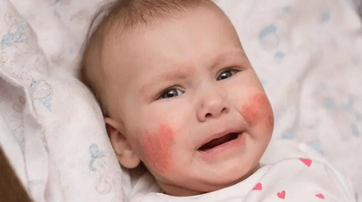 Infant Skin Allergy Treatment - A Comprehensive Guide