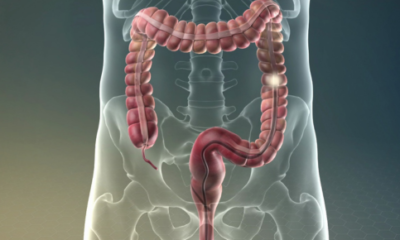 Navigating Your Colorectal Surgery Outpatient Appointment What to Expect